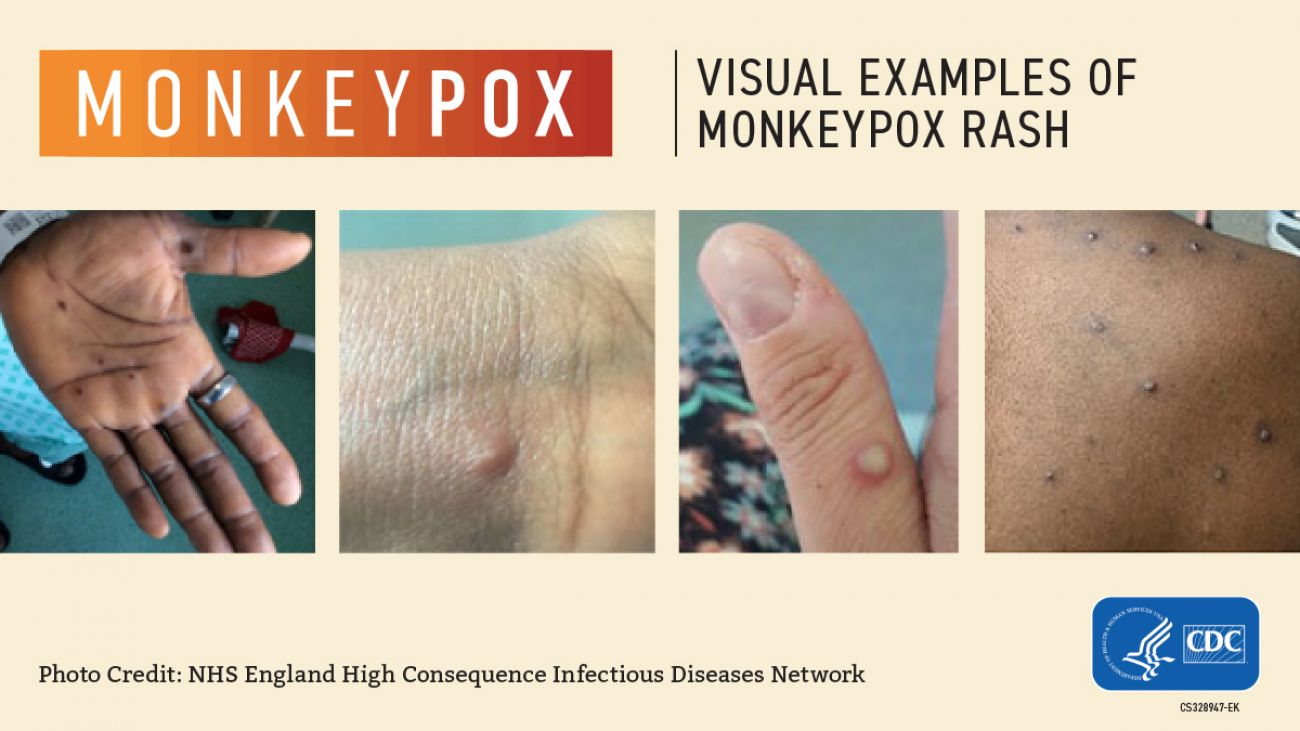 As Monkeypox Cases Spread Among Gay Men In Michigan Messaging Becomes   Cdc Visual 